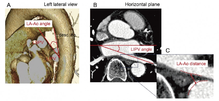 ALT: Diagram illustrating anatomical parameters related to esophageal proximity during catheter ablation, including LA-Ao angle, LIPV angle, and LA-Ao distance.