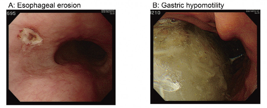 Esophageal erosion and gastric hypomotility observed in endoscopic images after catheter ablation.