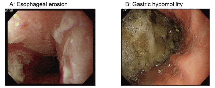 Esophageal erosion and gastric hypomotility observed during endoscopy after pulmonary vein isolation.