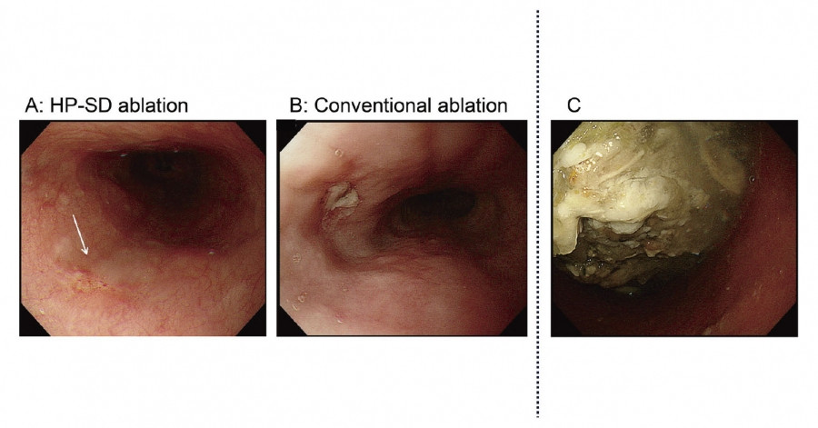 Images showing esophageal thermal injuries from high-power short-duration (HP-SD) and conventional ablation techniques, highlighting erythema, ulceration, and gastric hypomotility.