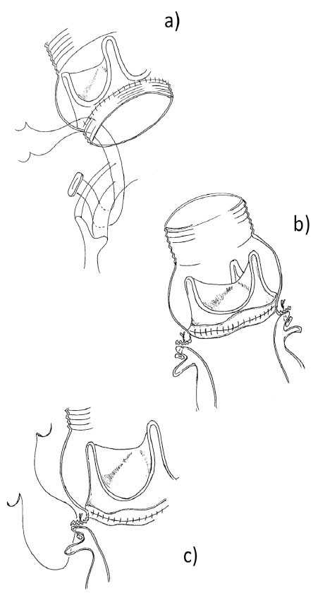 Illustration of the flanged technique for composite grafting in cardiac surgery, showing suturing methods for aortic valve prosthesis.