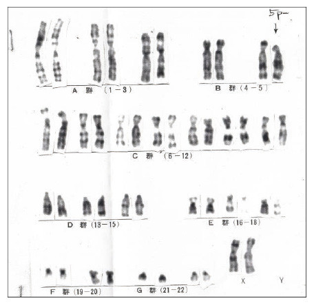 Chromosome analysis image displaying various chromosome pairs labeled A to G, including X and Y chromosomes.