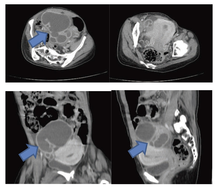 Contrast-enhanced CT images showing a tubo-ovarian abscess with a thick-walled mass and enlarged fallopian tube in a patient with cri du chat syndrome.