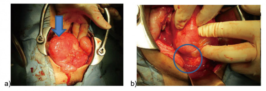 Intraoperative images showing a right tubo-ovarian abscess and endometriosis "blueberry spots" during laparotomy.