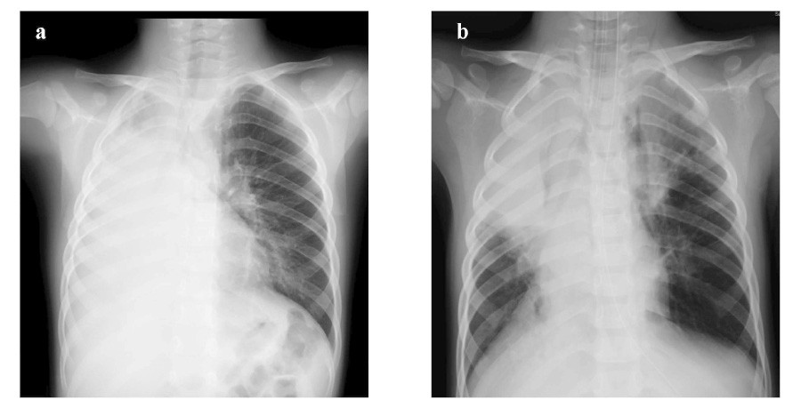 X-ray images showing two different views of the chest, highlighting lung conditions.