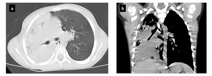 Chest CT images showing atelectasis in the right middle and lower lung lobes, with axial and coronal views.