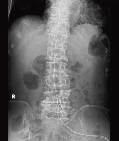 X-ray image showing the lumbar spine with visible vertebrae and surrounding structures.
