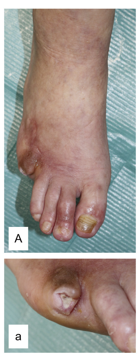 A right foot with a 1 cm ulcer at the base of the fifth toe, showing necrotic tissue and swelling.