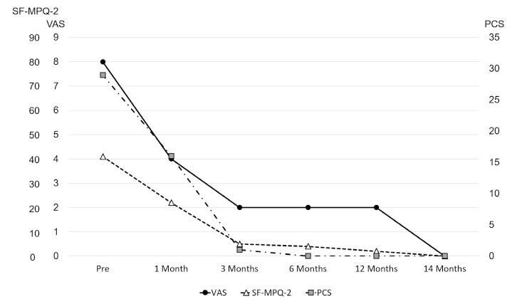 Graph showing pain scale results over time for spinal cord stimulation treatment, indicating significant pain reduction at 3 and 14 months postoperatively.