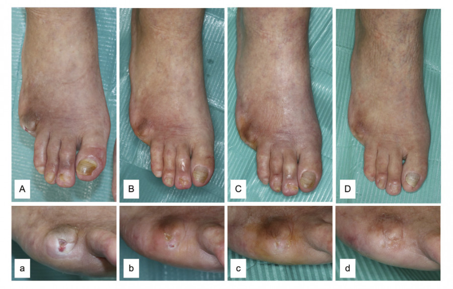 Healing process of a right foot ulcer over 12 months post-spinal cord stimulation, showing gradual improvement.