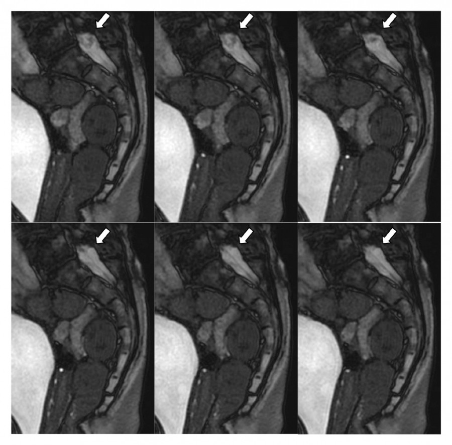 Cine MRI images showing cauda equina movement during Valsalva maneuver in a patient with lumbar spinal canal stenosis.