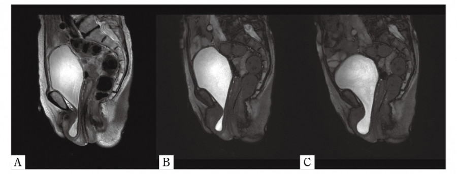 MRI images showing uterine and bladder prolapses during the Valsalva maneuver in two patients.