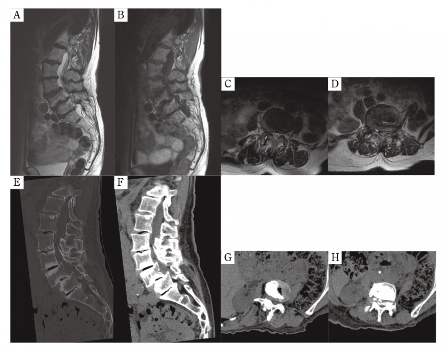 MRI and CT images showing lumbar spinal canal stenosis at L3/4 and L4/5 levels in two patients.