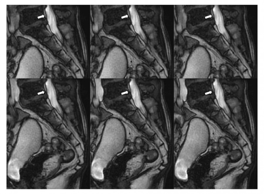Cine MRI images showing cauda equina movement during Valsalva maneuver in a patient with lumbar spinal canal stenosis.