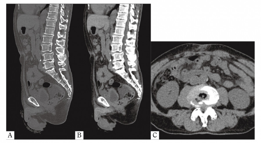 CT images showing lumbar spinal canal stenosis with sagittal and axial views.