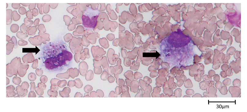 Microscopic view of blood cells, highlighting two distinct cells with purple staining, indicating cellular characteristics.