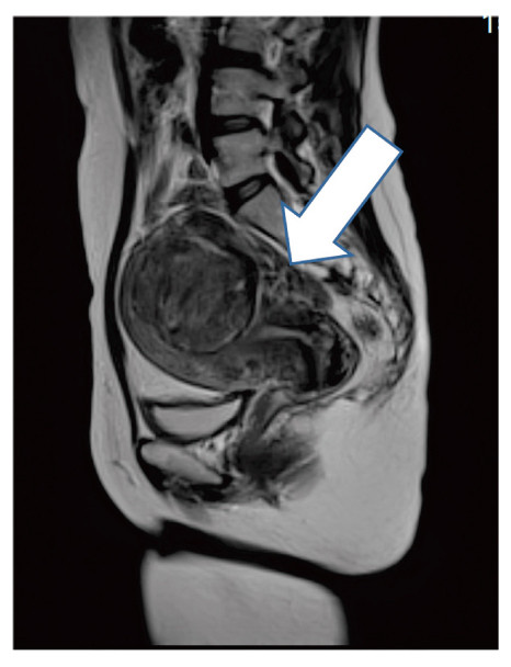 MRI scan showing enlarged uterine myomas in the pelvic cavity, indicated by an arrow.