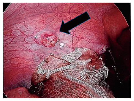 Intraoperative laparoscopic image showing a thumb-sized tumor on the left peritoneum after hysterectomy.