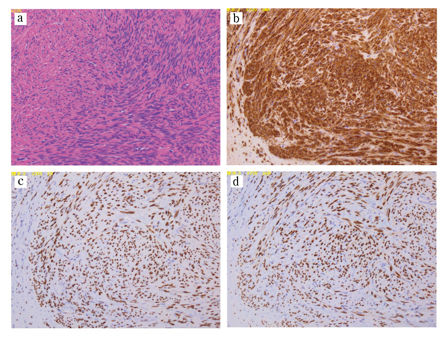 Microscopic view of a benign leiomyoma with positive immunohistochemical staining for smooth muscle actin, estrogen, and progesterone receptors.