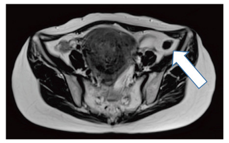 Coronal T2-weighted MRI scan showing a 1.8 × 1.0 cm low-density solid tumor in the left peritoneum post-laparoscopic surgery.