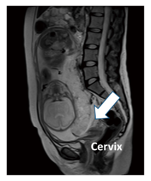 MRI image of the pelvis at 30 weeks of gestation showing partial placenta previa, with the cervix indicated by an arrow.