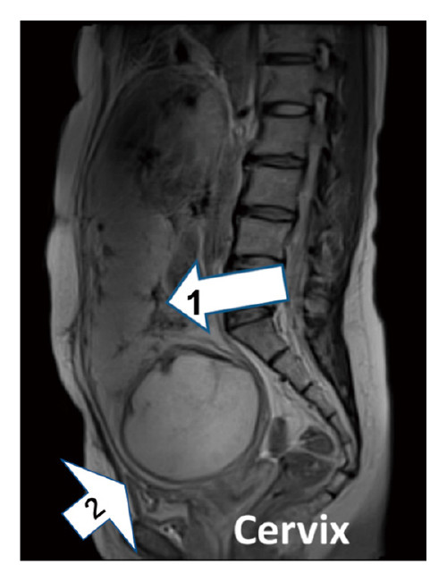 MRI of the pelvis at 30 weeks of gestation, showing the placenta on the anterior myometrium wall and a cesarean scar.