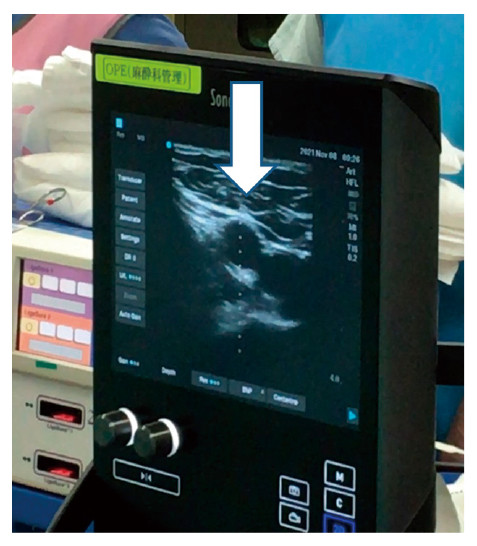 Ultrasound image showing the right femoral artery with a guide for sheath placement during spinal anesthesia.
