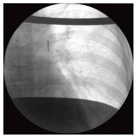 X-ray image showing the placement of a resuscitative endovascular balloon occlusion of the aorta above the celiac artery.