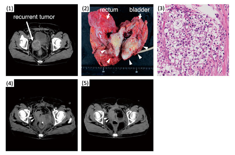 Medical imaging showing a recurrent tumor in the pelvic region, with highlighted rectum and bladder.