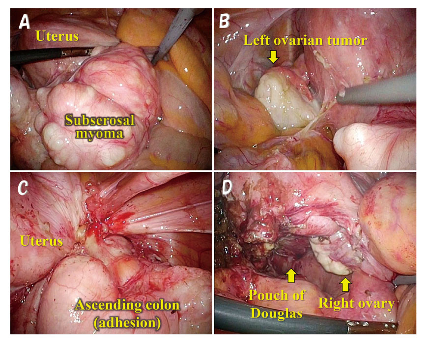 Medical images showing various anatomical structures: uterus, left ovarian tumor, ascending colon, and right ovary during a surgical procedure.