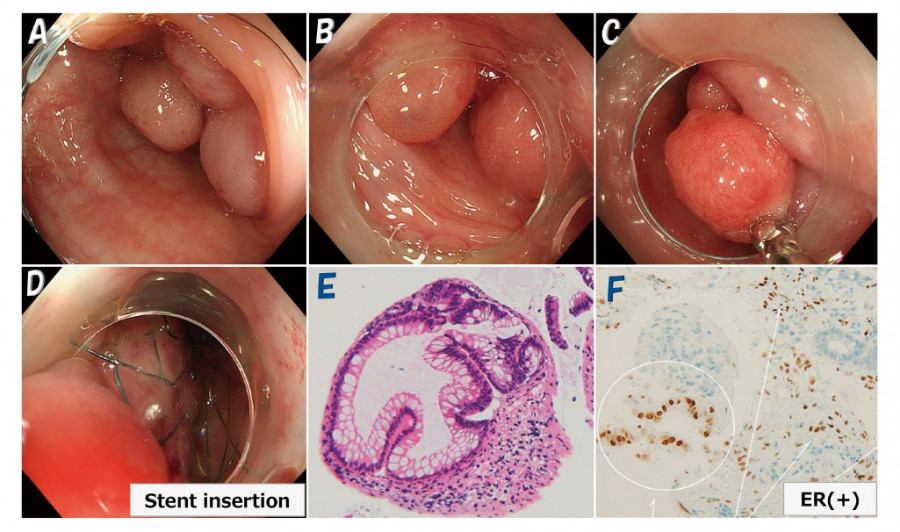 Medical images showing endoscopic views of a gastrointestinal tract, including stent insertion and histological analysis.