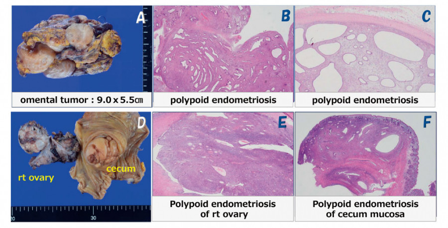Omental tumor and histological images of polypoid endometriosis, including sections from the right ovary and cecum.