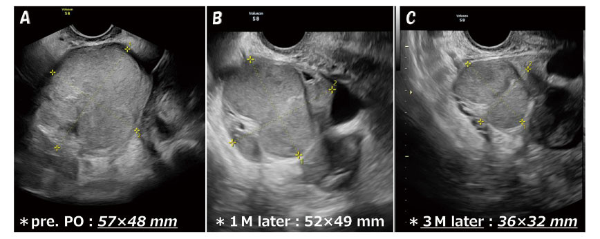 Ultrasound images showing a medical evaluation over three months, with measurements indicated for each stage.