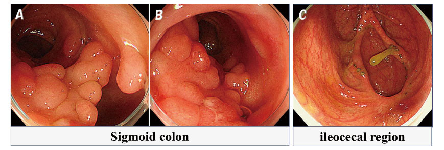Endoscopic images showing the sigmoid colon and ileocecal region with visible polyps and lesions.
