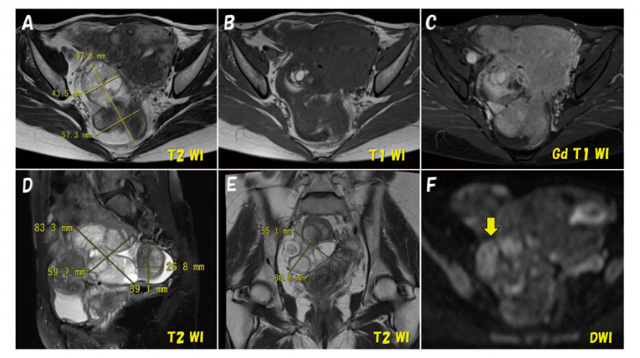 MRI images showing a right ovarian tumor with hyperintense mass characteristics and measurements, indicating potential endometriosis.