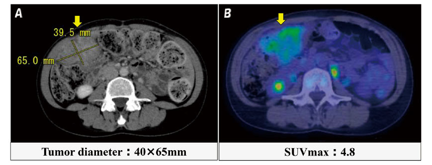 PET-CT images showing an omental tumor with faint FDG accumulation, indicating potential malignancy.