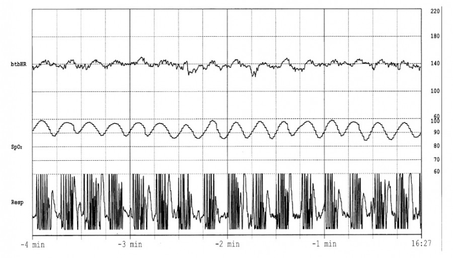 Graph displaying vital signs data, including heart rate, respiratory rate, and oxygen saturation over time.