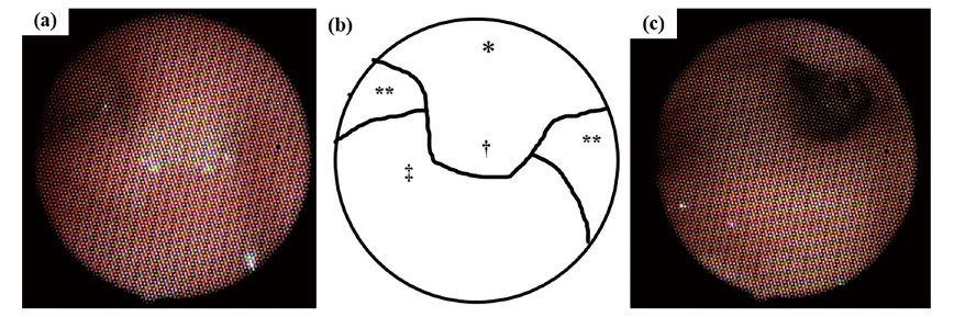Flexible fiberoptic laryngo-tracheo-bronchoscopy images showing the pharynx, soft palate, and uvula interactions.