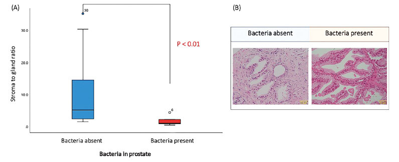 Box plot comparing stroma-to-gland ratio in prostate tissues with and without bacteria, alongside histological images.
