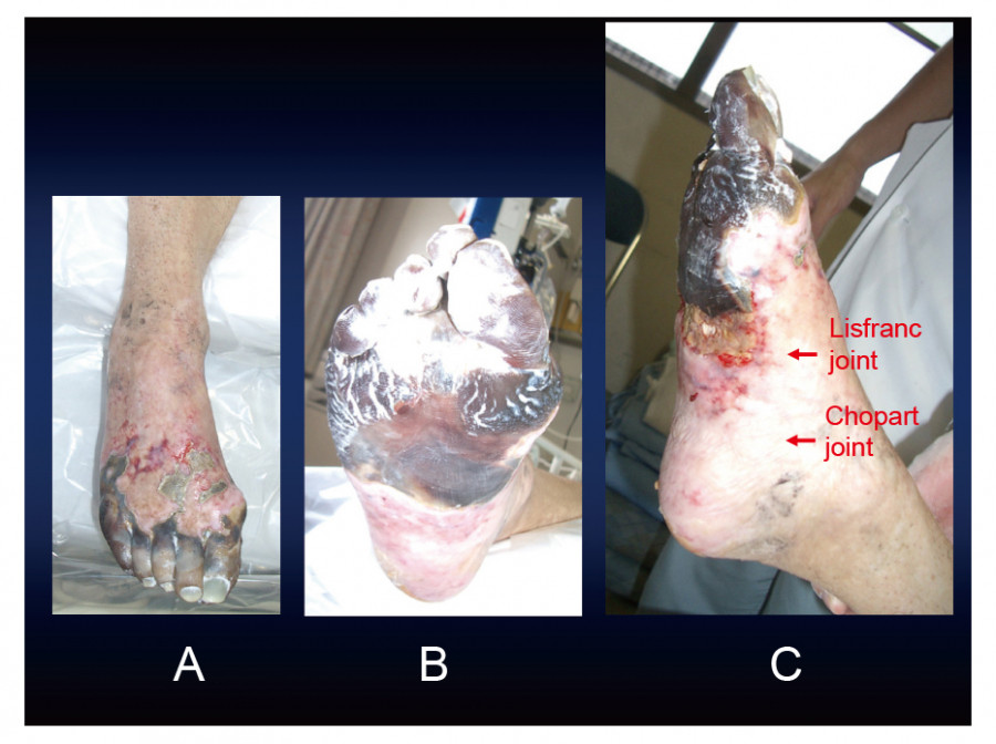 Necrotic foot with visible damage; images show front, plantar, and lateral views highlighting necrosis extent.