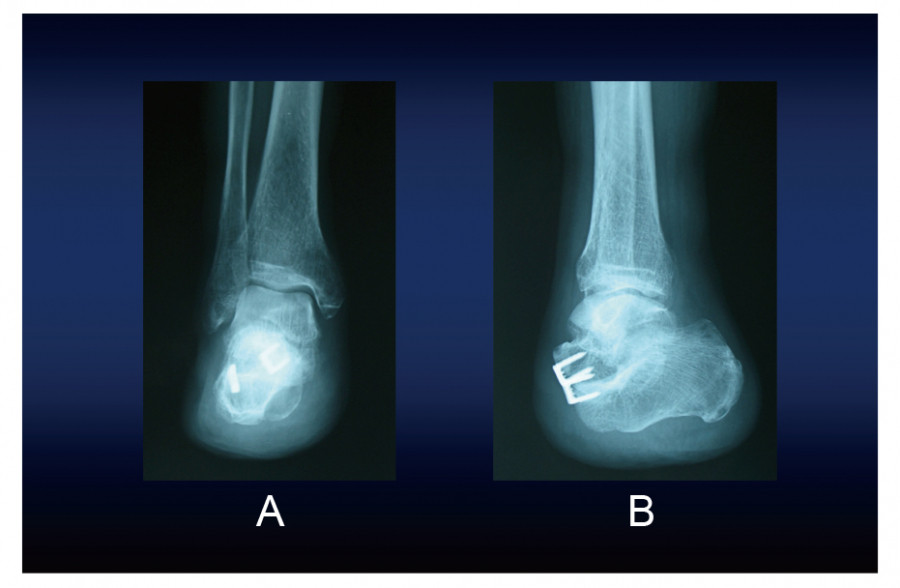 Postoperative radiographs showing anteroposterior (A) and lateral (B) views of a Chopart amputation without varus or equinus deformity.