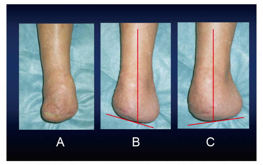 Frontal and lateral views of a right foot two years post-Chopart amputation, showing limited ankle motion.