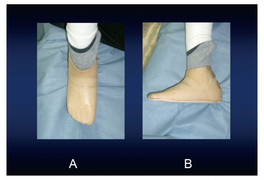 Foot prosthesis on the right foot, shown in front and side views, demonstrating tendon balancing after Chopart amputation.