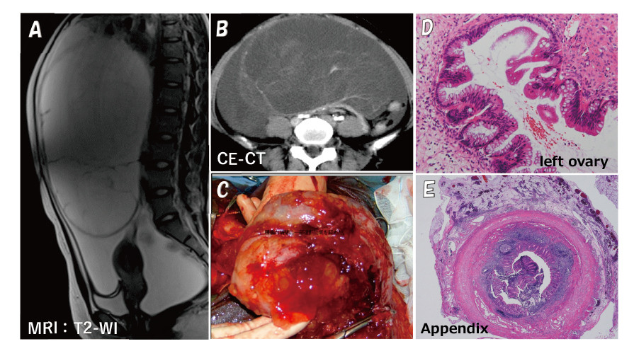 MRI and CT images showing anatomical details of the left ovary and appendix, highlighting medical conditions.