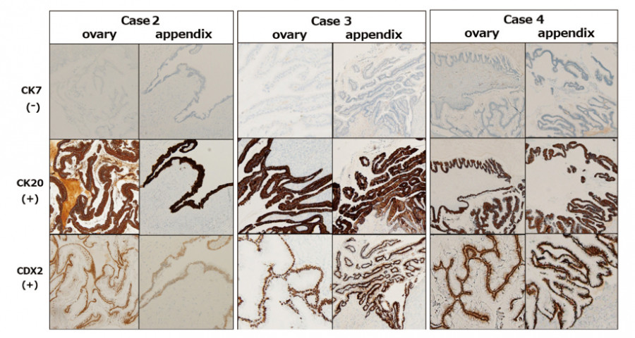 Microscopic images comparing CK7, CK20, and CDX2 staining in ovarian and appendiceal tissues across different cases.