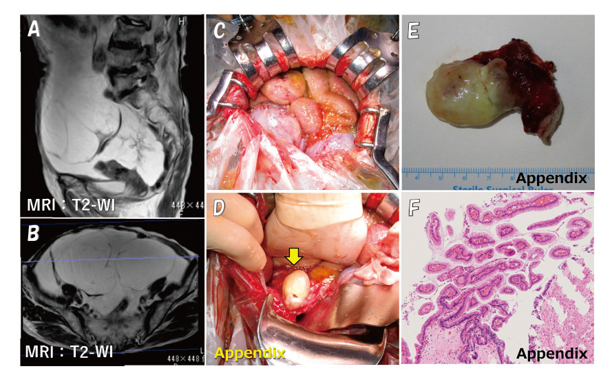 Medical images showing MRI scans and surgical views of the appendix, including histological samples.