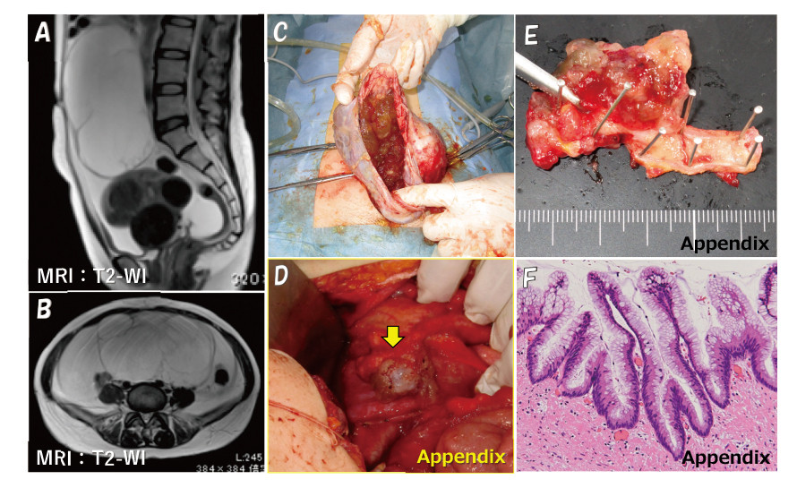 Medical images showing MRI scans and surgical procedures related to the appendix.