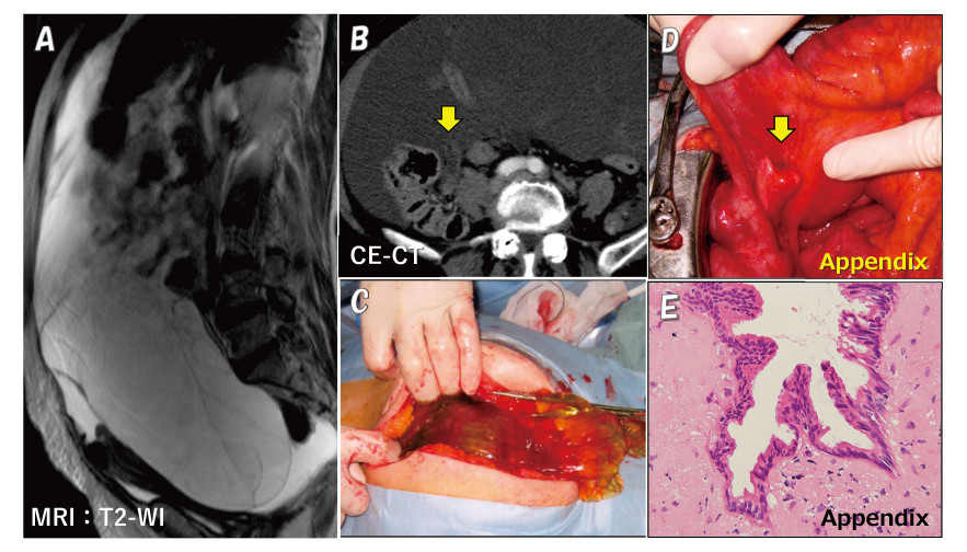 MRI and CT images showing a large multicystic ovarian tumor with ascites, surgical findings, and histopathological details.