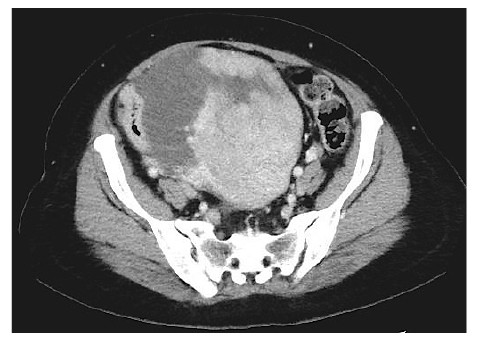 CT scan image showing a cross-sectional view of the pelvic region, highlighting anatomical structures and potential abnormalities.