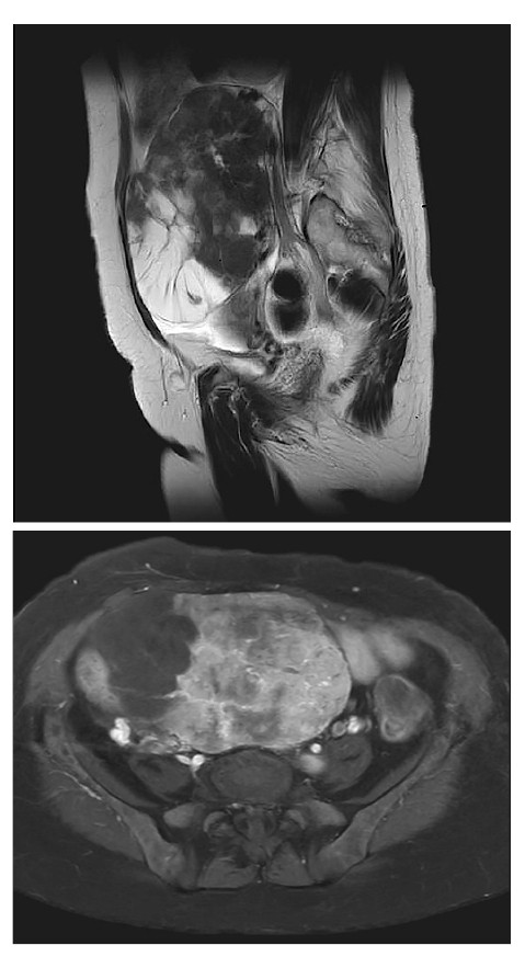MRI scans showing cross-sectional views of the pelvic region, highlighting anatomical structures.